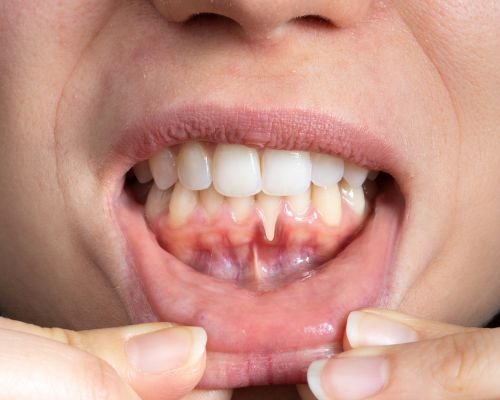 Periodontal Gum Treatment
